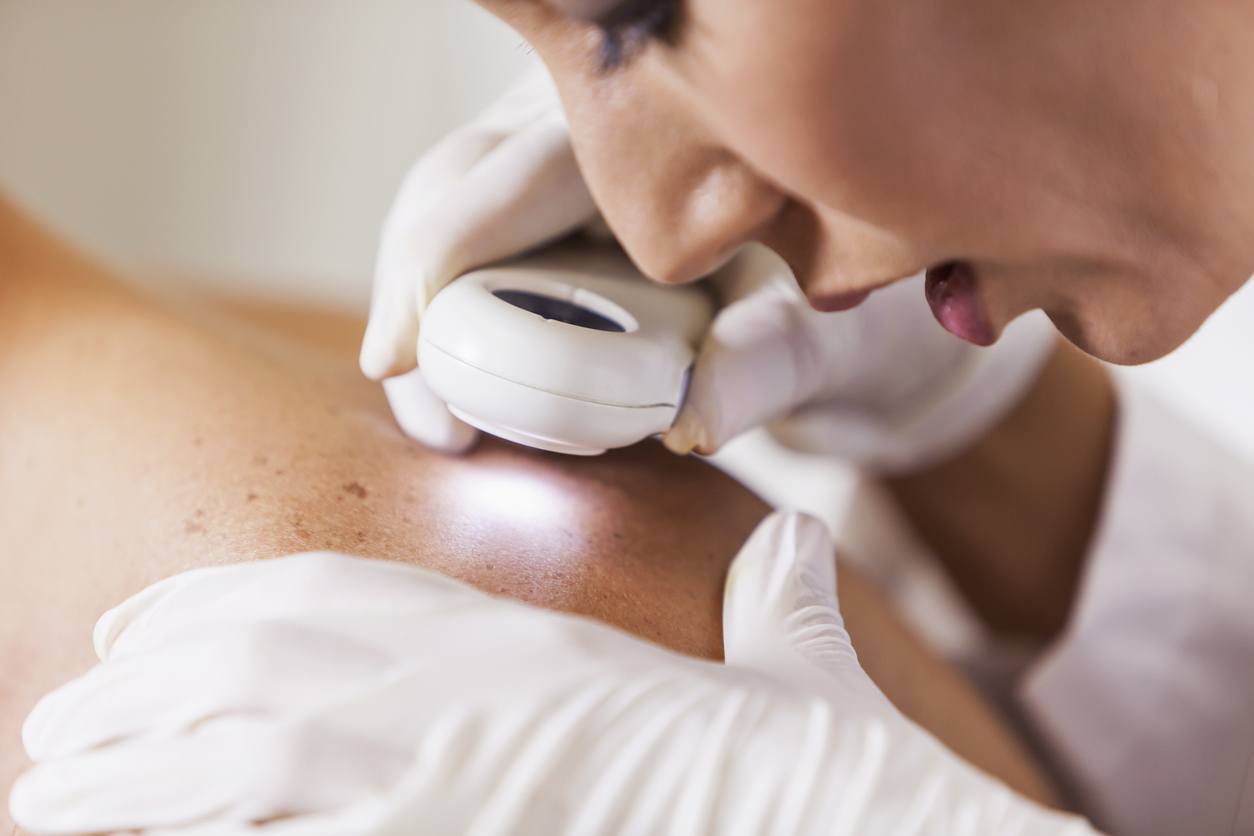 Pacientes diagnosticados com câncer de pele serão direcionados para o tratamento