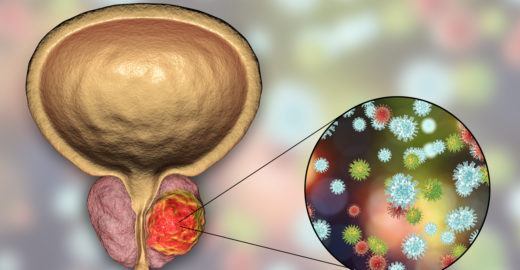 ilustração que mostra uma próstata com tumor