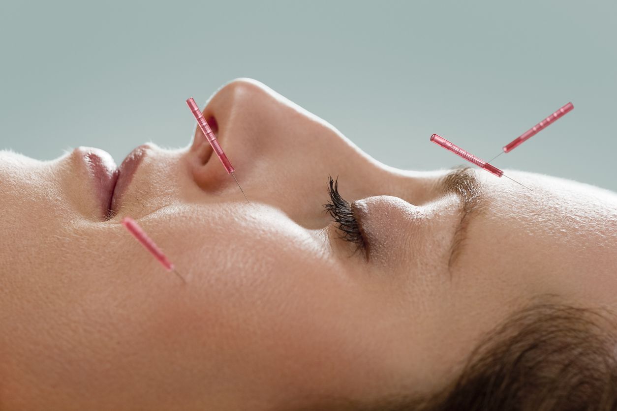Manchas e cicatrizes podem ser amenizadas com acupuntura facial
