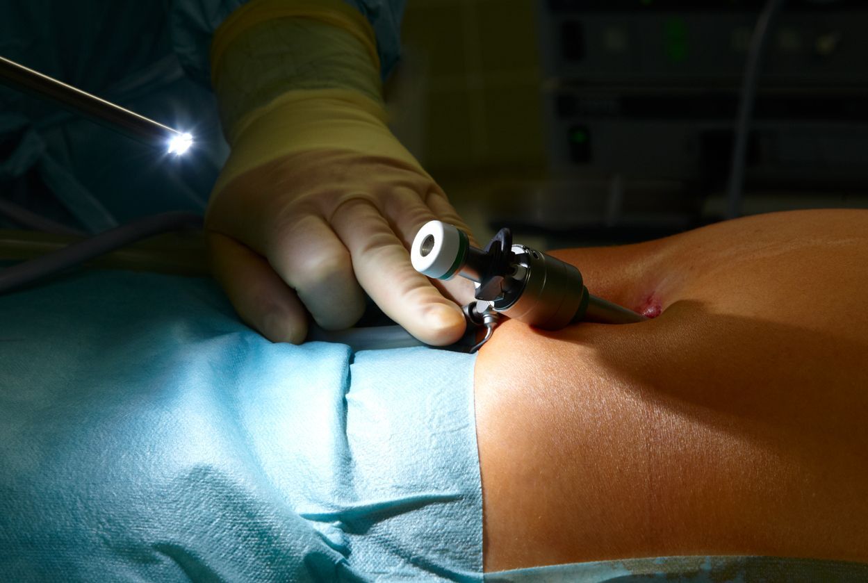 Laparoscopia é feita através de cortes mínimos na região abdominal