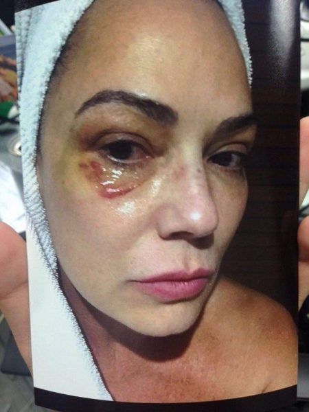 Na época, Luiza Brunet divulgou fotos mostrando os hematomas deixados pela agressão do ex-marido