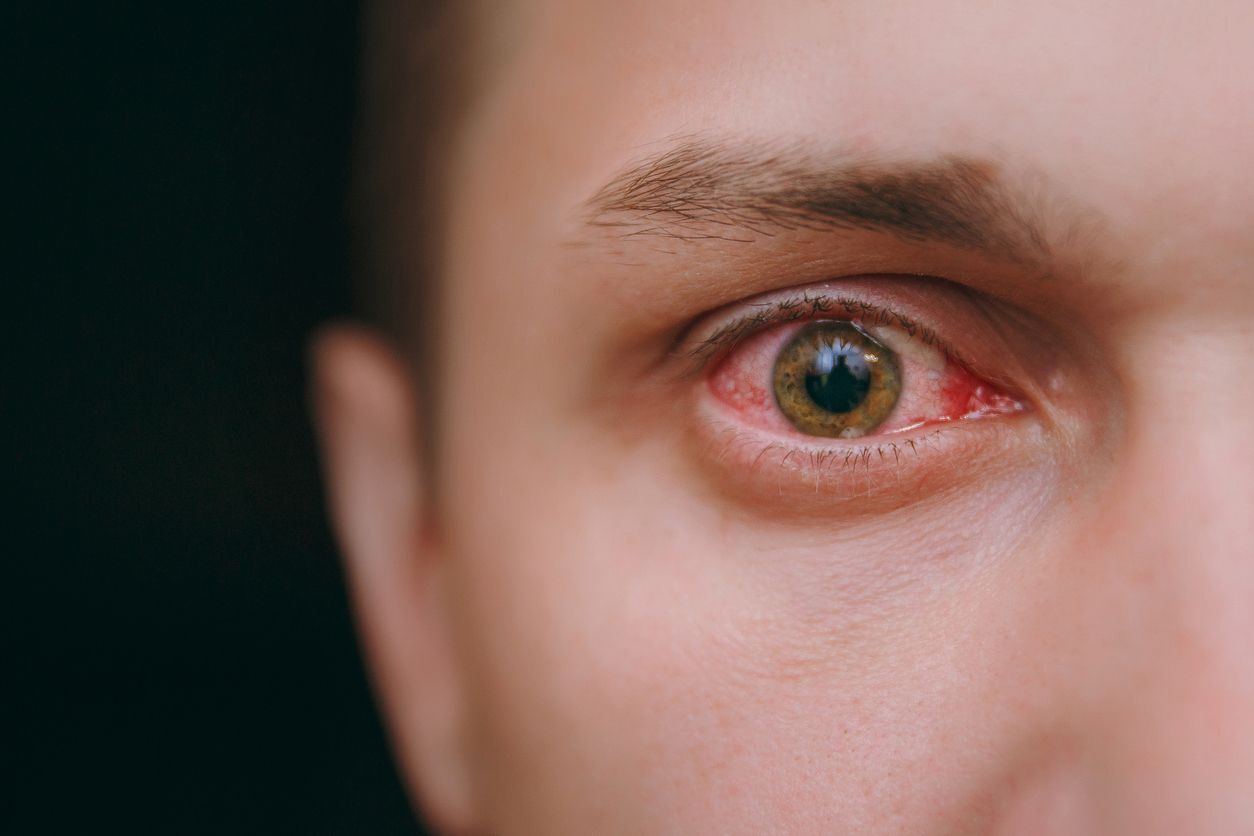 Sífilis ocular causa vermelhidão e dor nos olhos