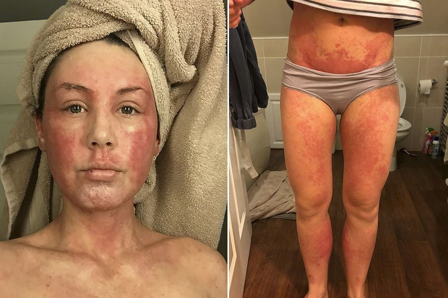 Manchas avermelhadas da eczema se espalharam por todo o corpo