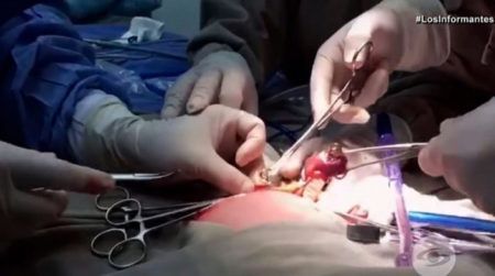 Cirurgia foi realizada 24h após o nascimento