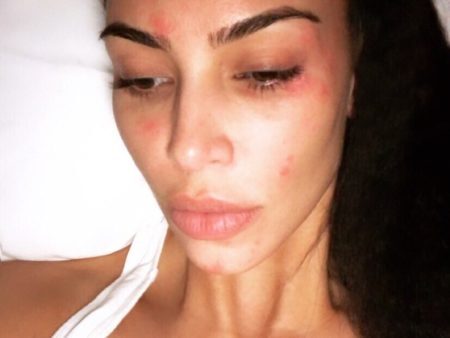Kim Kardashian mostra as manchas da doença no rosto
