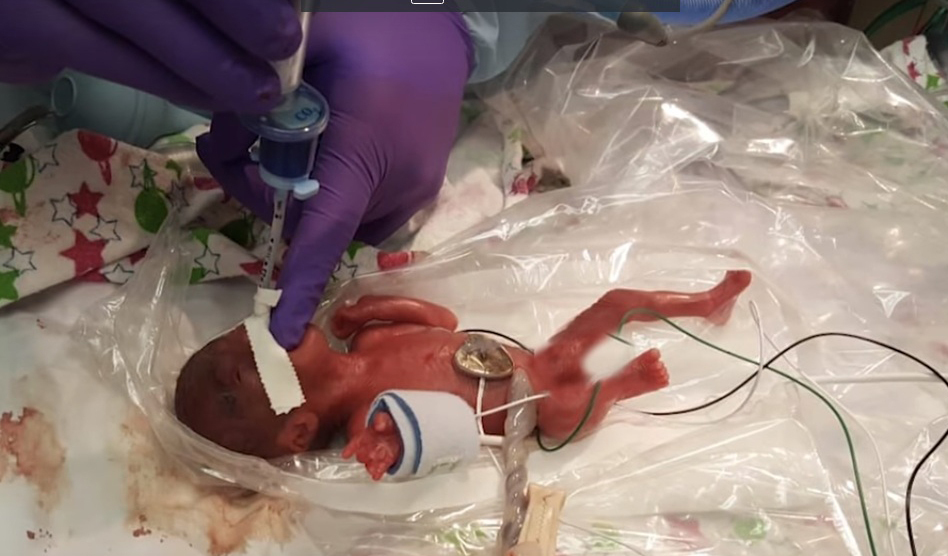 Bebe Que Nasceu Com 245 Gramas Recebe Alta Do Hospital