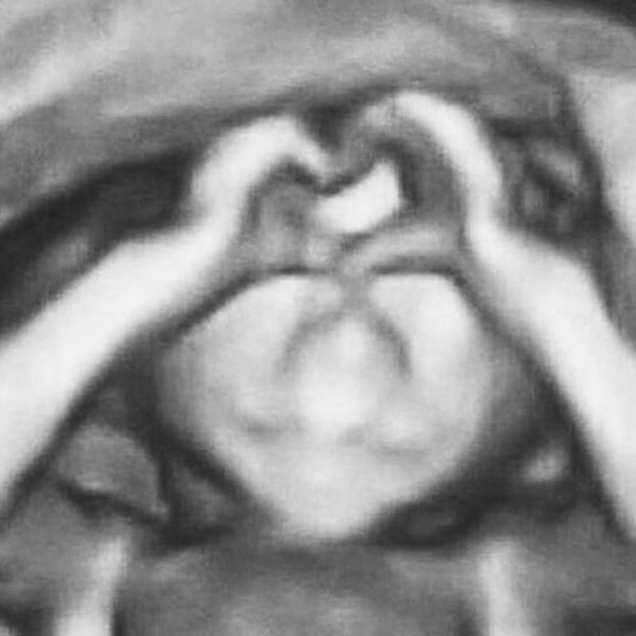 Em ultrassom, bebê une as mãos e faz parecer um coração