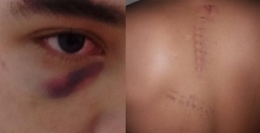 Jovem mostra marcas de agressões sofridas em Centro Educacional em Teresina (PI)