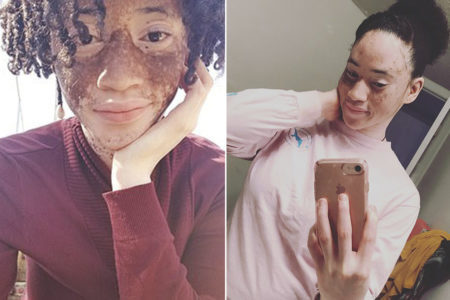  Estudante diz que manchas do vitiligo diminuíram após dieta vegana