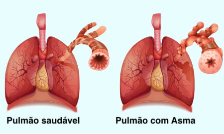 A asma é uma doença pulmonar inflamatória crônica, caracterizada pelo fechamento reversível dos brônquios