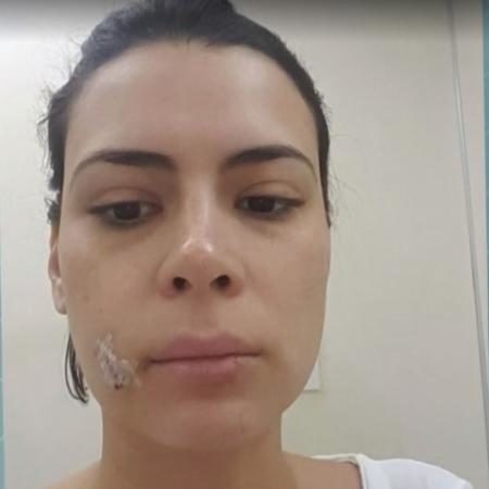 A jornalista Michelle Loreto mostro o rosto após ser mordida por sua cadela de estimação