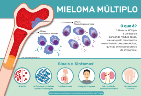 Fadiga, anemia e lesões ósseas são alguns dos sintomas do mieloma múltiplo