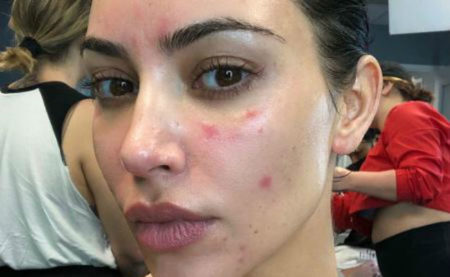 Kim Kardashian sofre com tratamento para psoríase