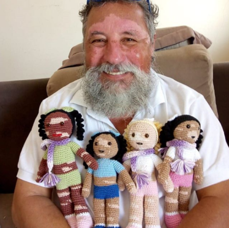 João Stanganelli, de 64 anos, é portador do vitiligo