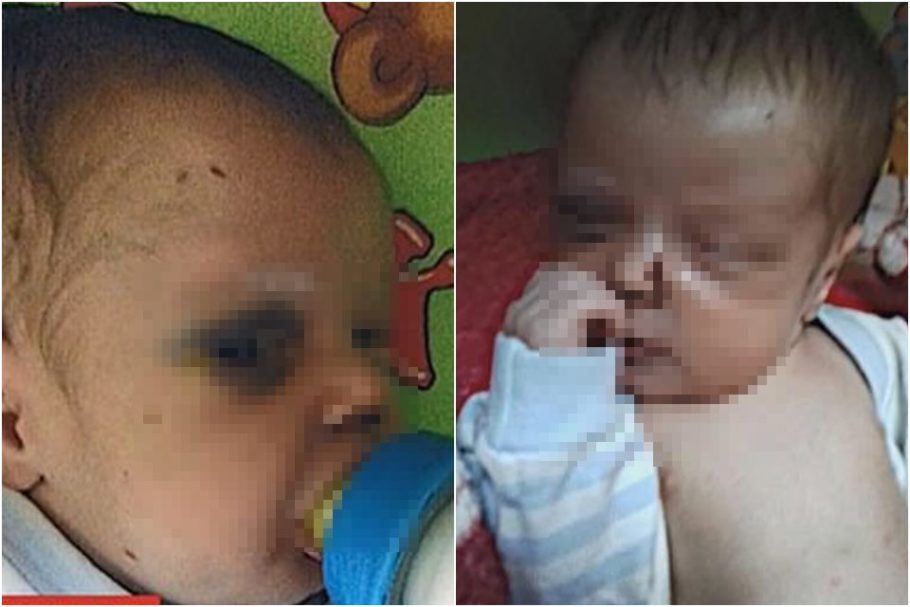 Bebê foi encontrado sozinho com olho roxo e diversos hematomas pelo corpo