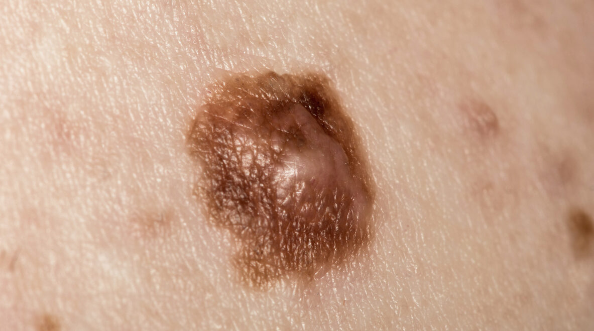 O câncer de pele pode ser classificado como melanoma ou não melanoma