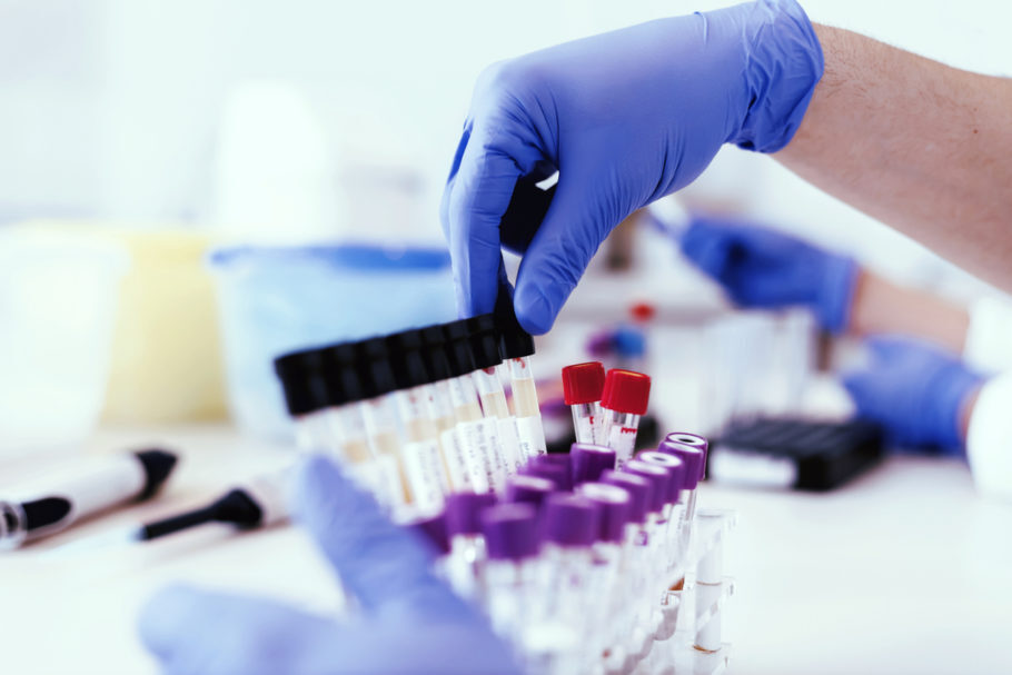 Novo exame de câncer de próstata detecta células cancerígenas precoces no sangue