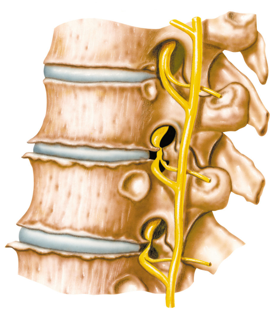 ilustração da coluna vertebral com espondilite