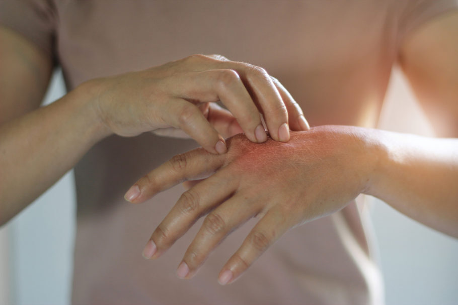 O eczema é um tipo de dermatose que se caracteriza por apresentar vários tipos de lesões