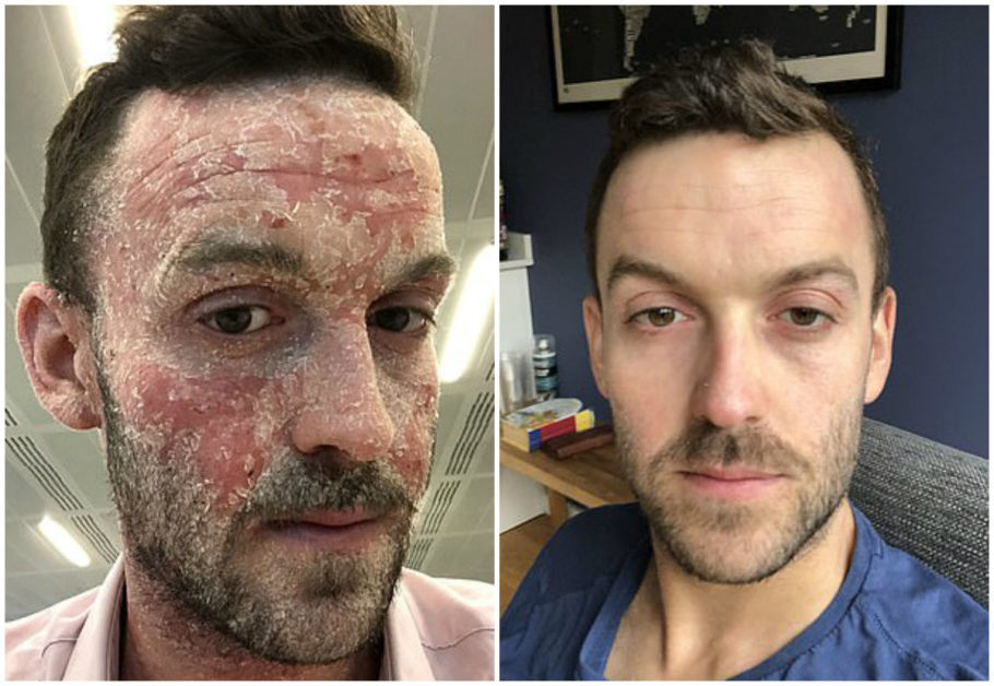  O britânico Jonathan Rowe, 32 anos, mostra a transformação no rosto