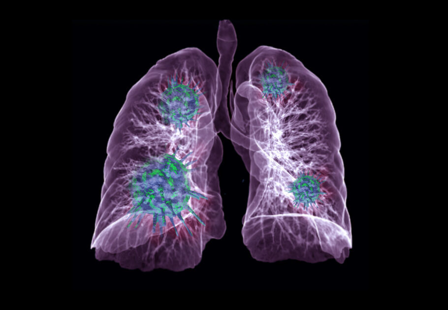 Plataforma reúne raios-X e tomografias do pulmão de pacientes com suspeita ou com diagnóstico positivo do coronavírus