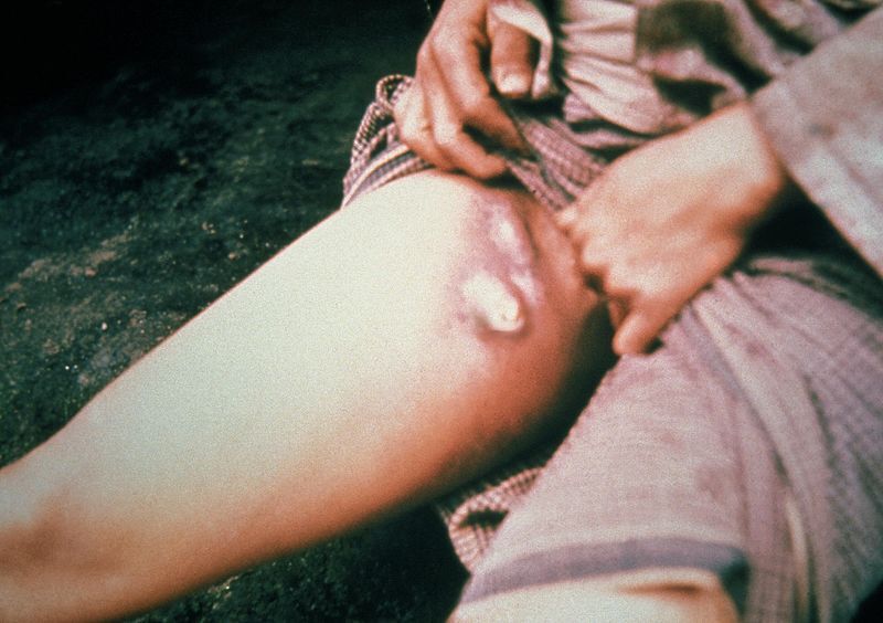 Peste bubônica forma nódulos inflamados na região da virilha de um infectado