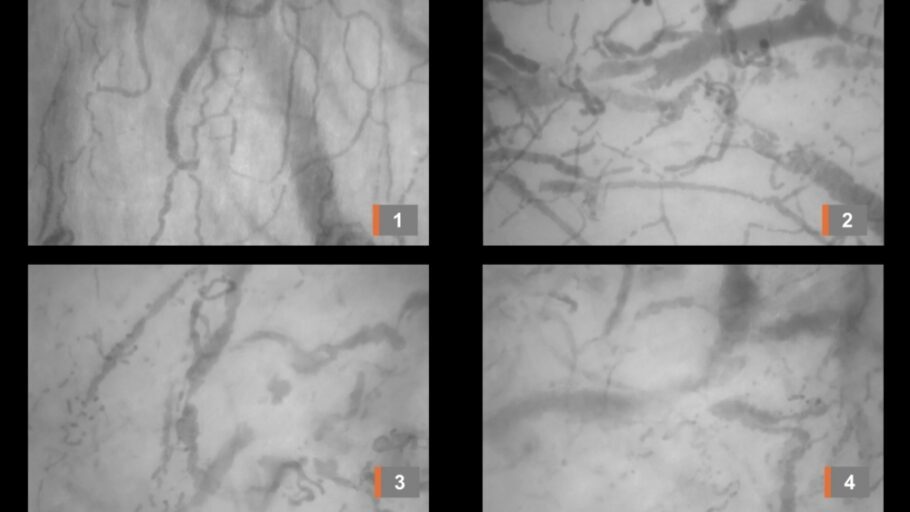 Imagem 1 mostra a microcirculação normal; as imagens 2 e 3 registram sinais de problemas na circulação e, a imagem 4, capta a obstrução tromboembólica aguda