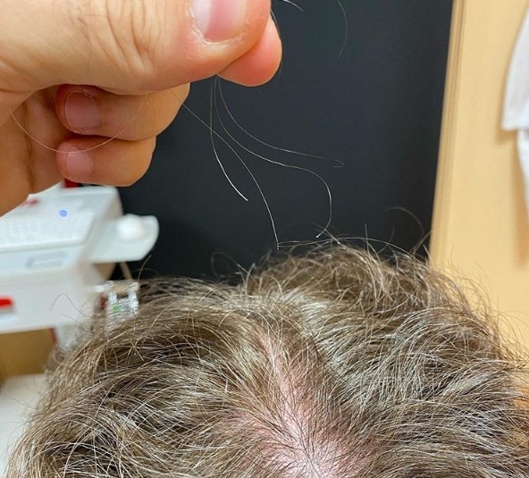 Queda de cabelo afeta homens e mulheres recuperados de covid-19
