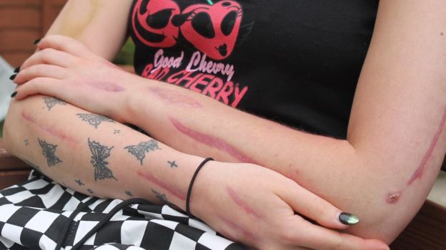 Para amenizar as cicatrizes, a britânica  Charlotte Evans, 19 anos, fez tatuagens de borboletas; doença ainda não foi diagnosticada