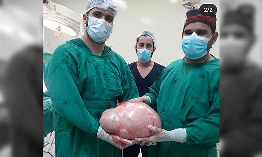 Tumor de quase 20 quilos é retirado do ovário de paciente em Cruzeiro do Sul (AC)