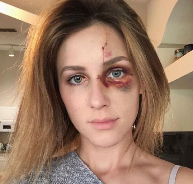 Melissa publicou imagens nas redes sociais que mostram os hematomas após as agressões de Erick, em 2018