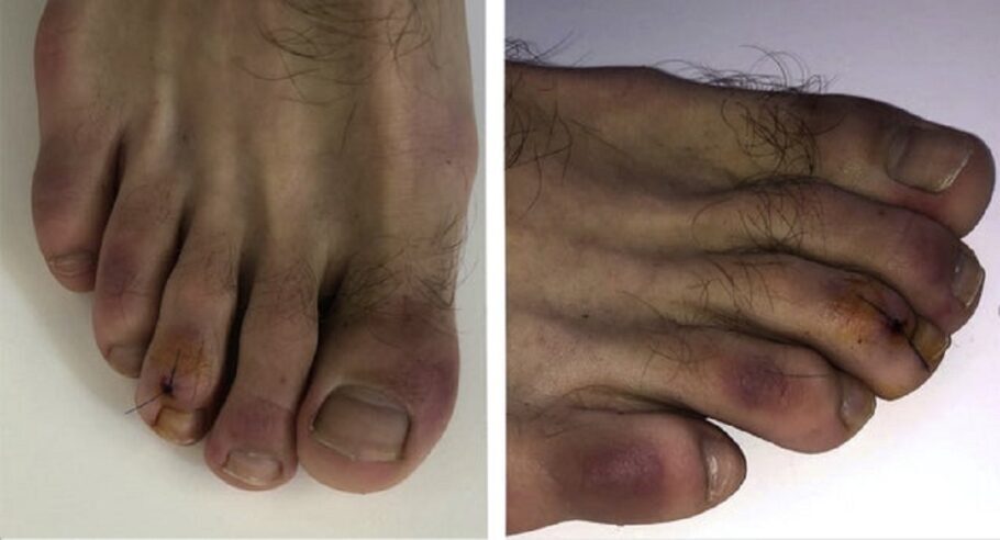 Novo sintoma tem sido chamado de “pés de covid”