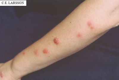 Lesões na pele em forma de nódulos