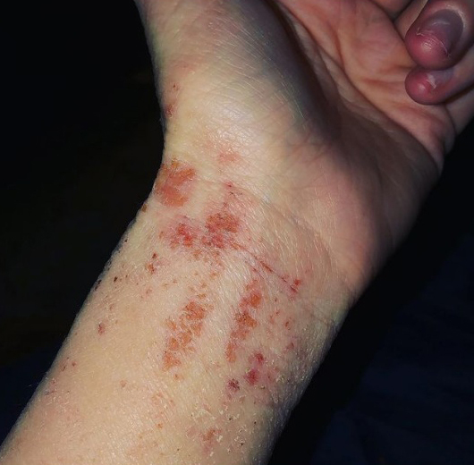 Eczema se espalhou por todo o corpo após ela abandonar os esteroides tópicos