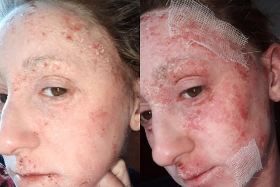  Eczema deixou a pele do rosto de Elin toda descamada