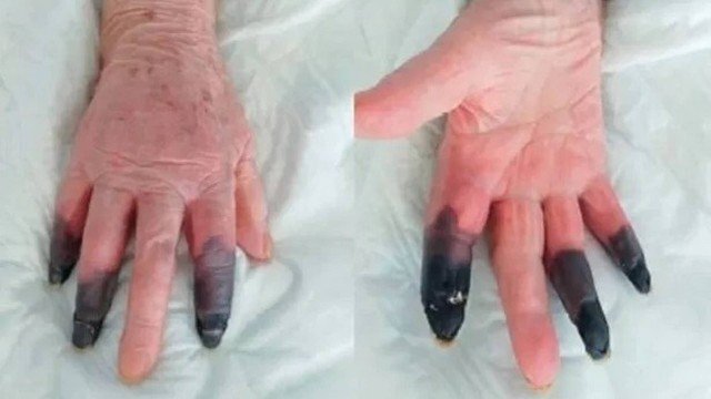 Idosa precisa amputar os três dedos da mão após reação rara à covid-19