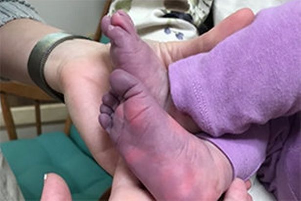 Síndrome pós-covid deixou membros de bebê azulados