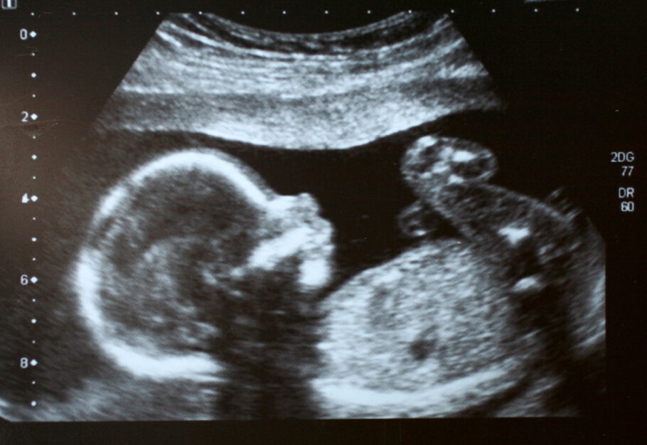 Bebê morre no útero infectado com a covid-19