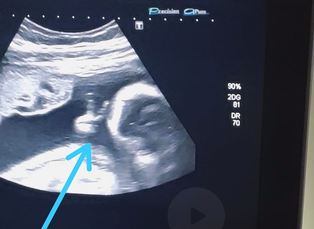 Bebê faz “v de vitória” em ultrassom e pai com câncer raro vê sinal divino