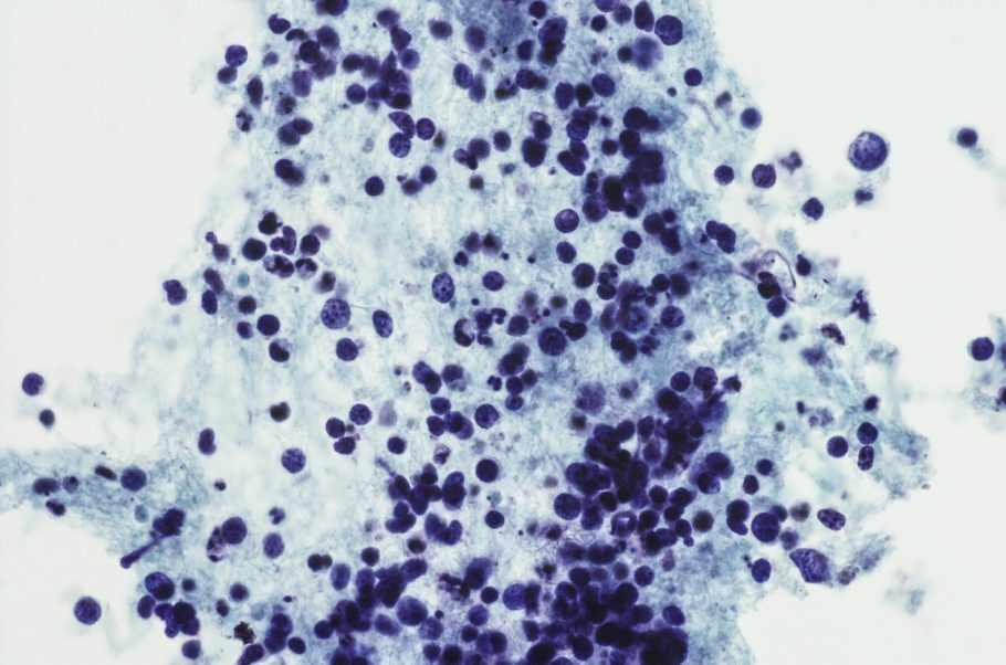 Células cancerígenas indicando câncer de pulmão