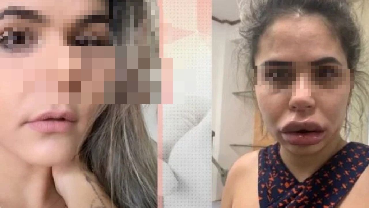 40 mulheres acusam dentista de deformar rostos após harmonização facial