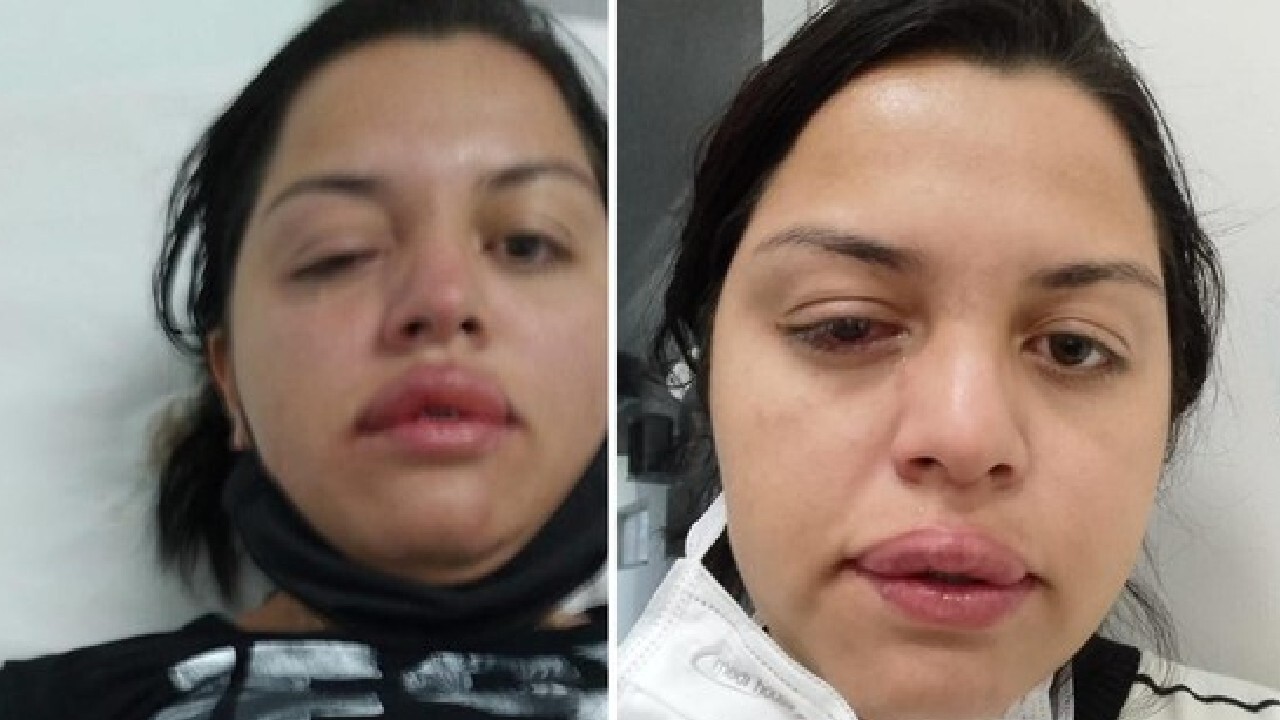 A faxineira Francieli Priscila Correa Froelich afirma ter sido atacada com ácido no rosto