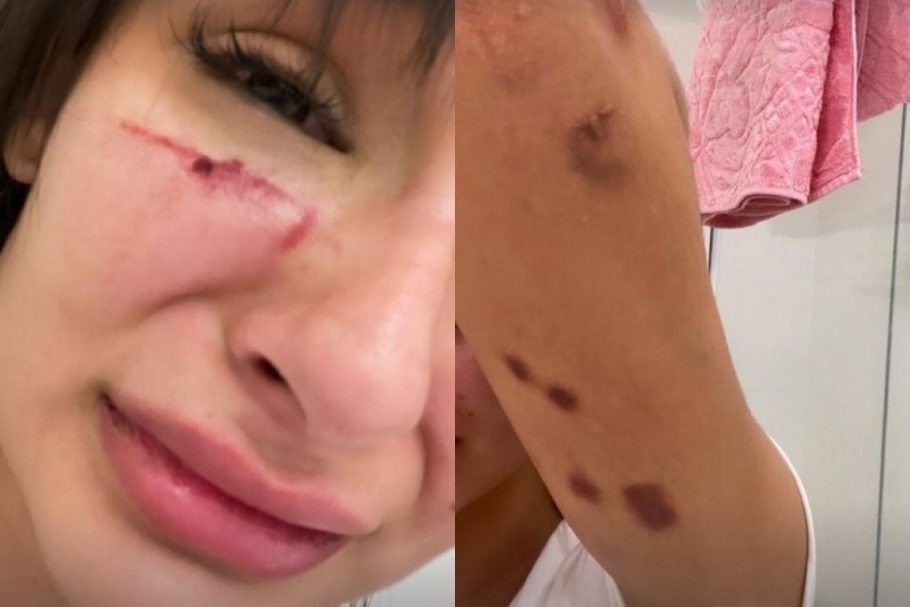 Modelo Anna Figueiredo denuncia ex-namorado após ser espancada