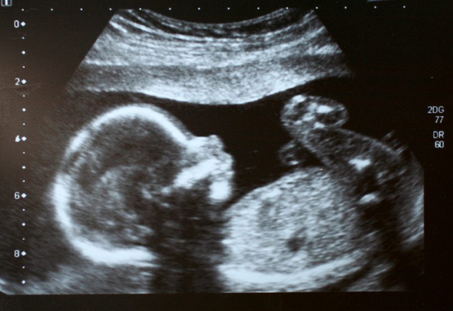 Identificada infecção pulmonar em feto abortado na 34ª semana