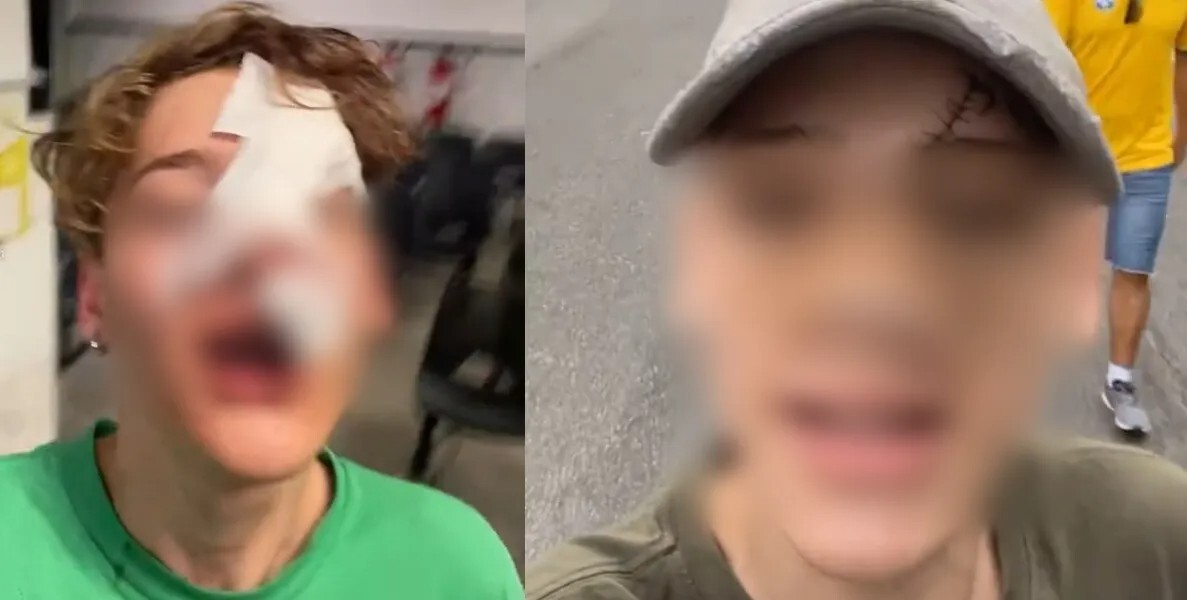 Influenciador digital de 16 anos precisou levar pontos na mão e no rosto após briga na Praia Grande (SP)