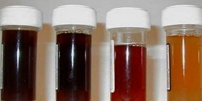 Se não tratada, a “doença da urina preta” pode levar a morte