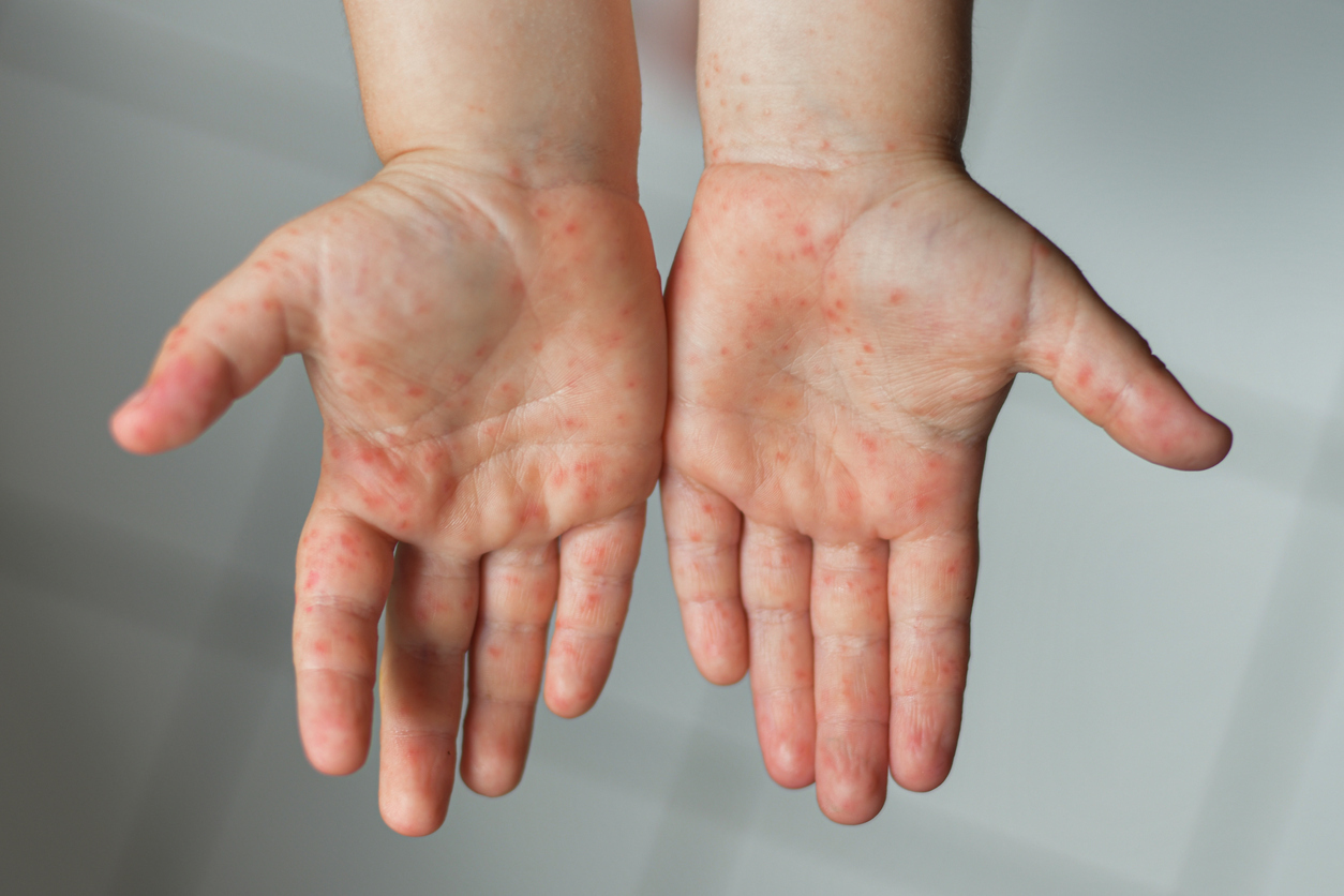 Doença comum na infância é caracterizada por febre alta e a dor de garganta, antes do aparecimento das manchas – iStock/Getty Images