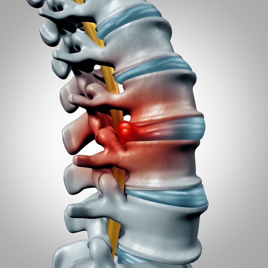  Estenose do canal vertebral causa dores e é mais comum após os 50 anos