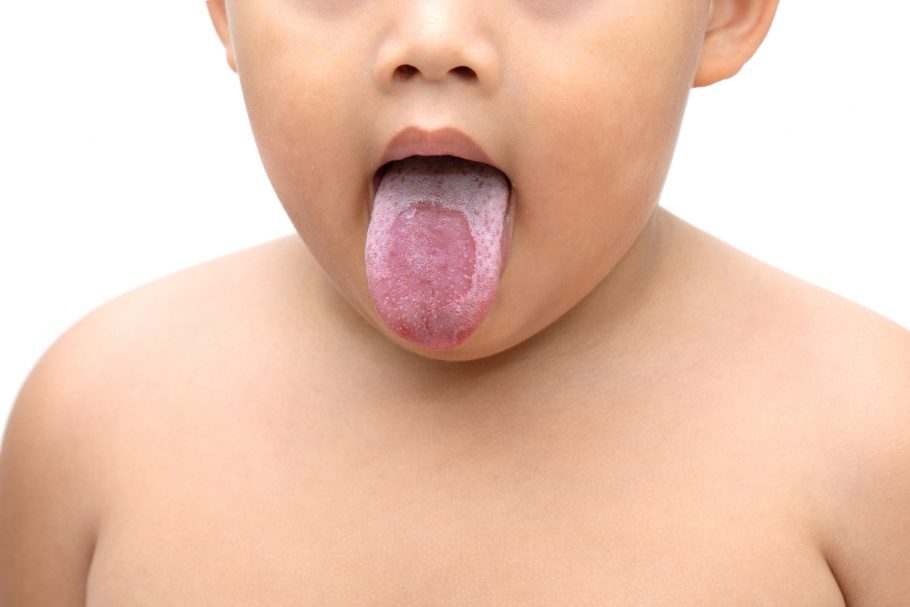 Sapinho causa placas brancas na língua