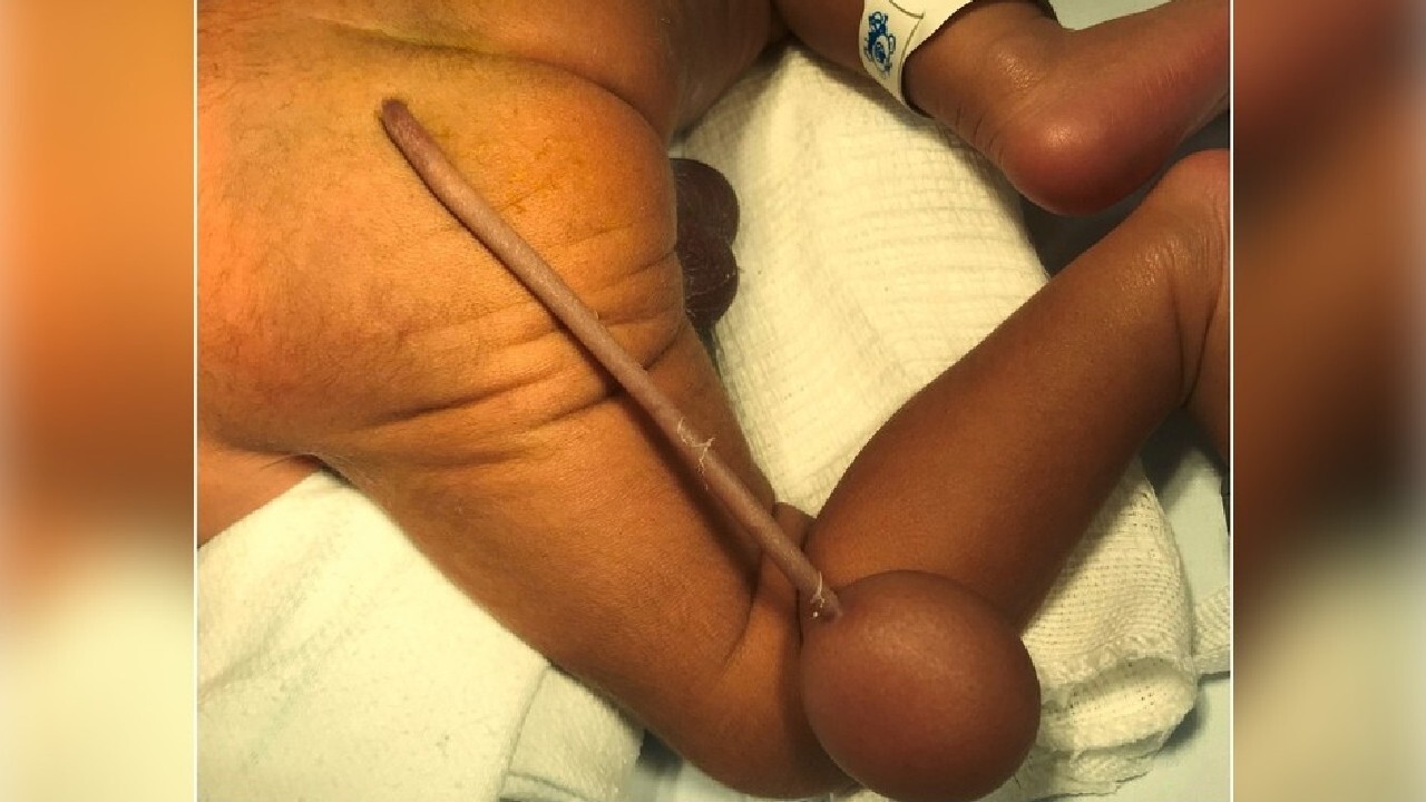  Caso do bebê prematura que nasceu com ‘cauda’ de 12 cm e bola é raro no mundo